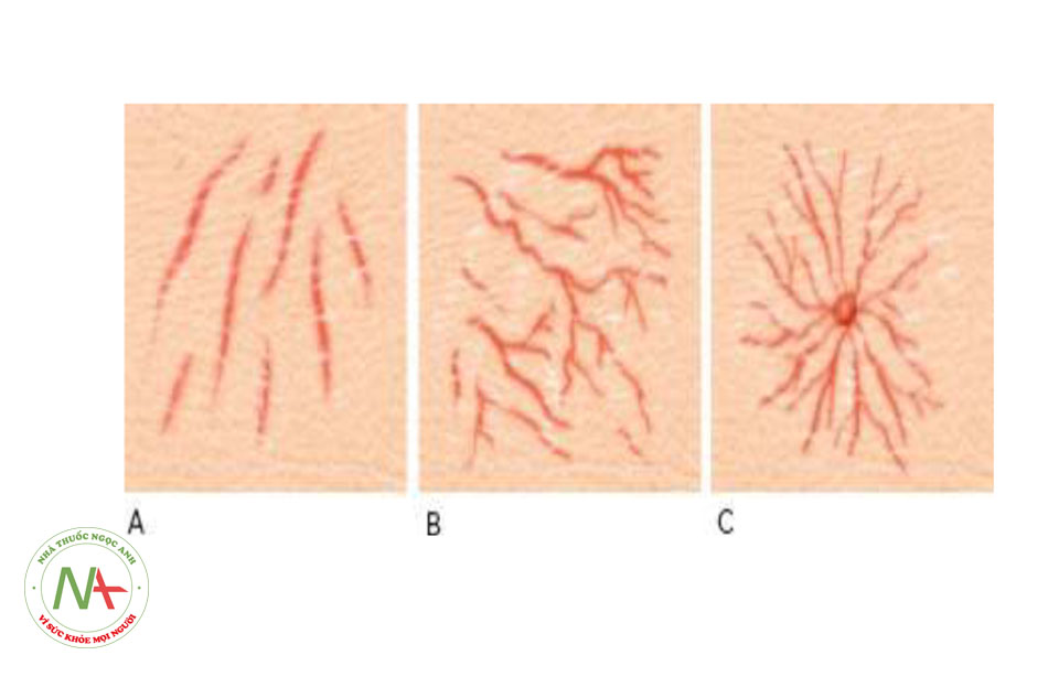 HÌNH 2 Giãn mao mạch theo đường thẳng (A) và dạng thân gỗ (B), và dạng u mạch mạng nhện (C)