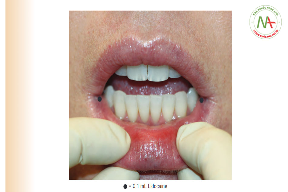 Hình 6 Sự xâm nhập cục bộ lidocaine để gây tê các góc môi.