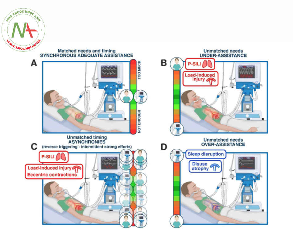 Hình 4. Các hình thức tương tác khác nhau giữa bệnh nhân và máy thở. Trong quá trình thở máy hỗ trợ, toàn bộ công việc để làm phổi phồng lên là sự kết hợp của các hoạt động được thực hiện bởi người thở và bệnh nhân. Các tình trạng lâm sàng khác nhau được hiển thị khi tỷ lệ công việc khác nhau được thực hiện bởi bệnh nhân hoặc máy thở như được minh họa bằng sơ đồ bằng thang đo ở mặt bên của mỗi hình (theo chiều kim đồng hồ A – D). A - Cho thấy một bệnh nhân có thông khí hỗ trợ đồng bộ và công việc được thực hiện ngang nhau giữa bệnh nhân và máy thở. D và B cho thấy máy thở thực hiện quá nhiều hoặc không đủ so với nhu cầu của bệnh nhân (hỗ trợ quá mức và dưới mức), dẫn đến nỗ lực hô hấp thấp và quá mức tương ứng. Những điều kiện này có liên quan đến những hậu quả bất lợi tiềm ẩn. Teo cơ hoành và gián đoạn giấc ngủ có thể xảy ra khi được hỗ trợ quá mức (trong bối cảnh các hiện tượng ngừng thở như được hiển thị trong màn hình máy thở dẫn đến thường xuyên bị kích thích và thức giấc). Ngược lại, sự trợ giúp dưới mức với nỗ lực quá mức có thể dẫn đến bệnh nhân tự gây tổn thương phổi và chấn thương cơ hoành do tải lực. C - Cho thấy một điều kiện duy nhất, sự xuất hiện của kích hoạt ngược lại với những nỗ lực mạnh mẽ. Trong tình trạng này, hơi thở thụ động (nơi máy thở thực hiện tất cả công việc) xen kẽ với nhịp thở do máy kích hoạt, sau đó là nỗ lực của bệnh nhân có thể dẫn đến quá trình thở dồn dập (như được thấy trên màn hình của máy thở). Các hậu quả bất lợi có thể xảy ra cũng được trình bày bao gồm sự xuất hiện của các cơn co thắt lệch tâm có thể gây tổn thương cao (co cơ hoành trong quá trình kéo dài - thở ra). Vent: máy thở, P-SILI: bệnh nhân tự gây chấn thương phổi.