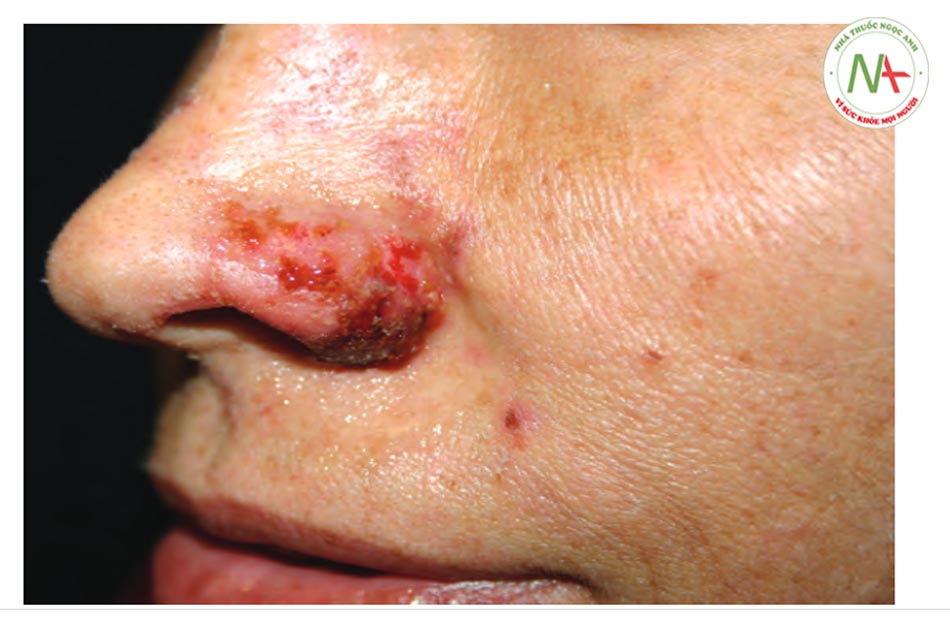 FIGURE 8 ●Hoại tử cánh mũi sau điều trị làm đầy da (theo L. Baumann, M.D.).