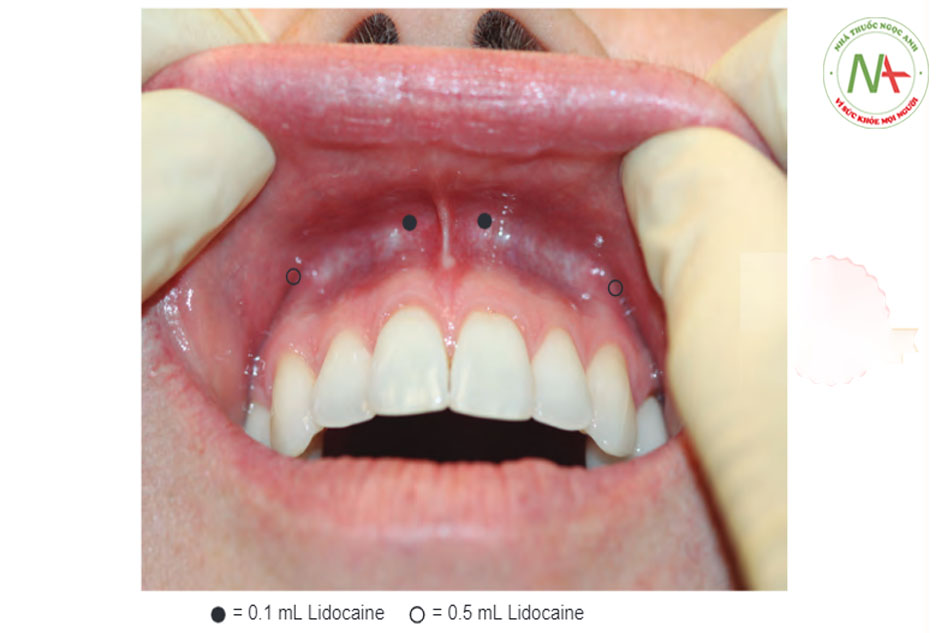 Hình 5 ng quan về các vị trí tiêm khối vòng và liều của môi trên.