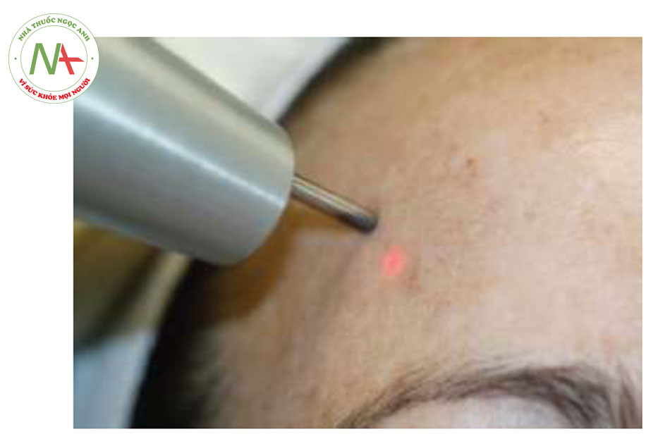 HÌNH 3 Kỹ thuật điều trị tái tạo bề mặt da không xâm lấn sử dụng đầu Q-switched 1064 nm laser.