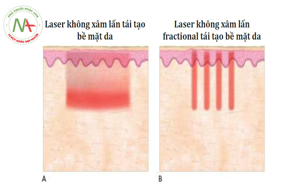 HÌNH 2 Các phần của laser không xâm lấn của tổn thương ở da: nonfractional (A) và fractional (B)