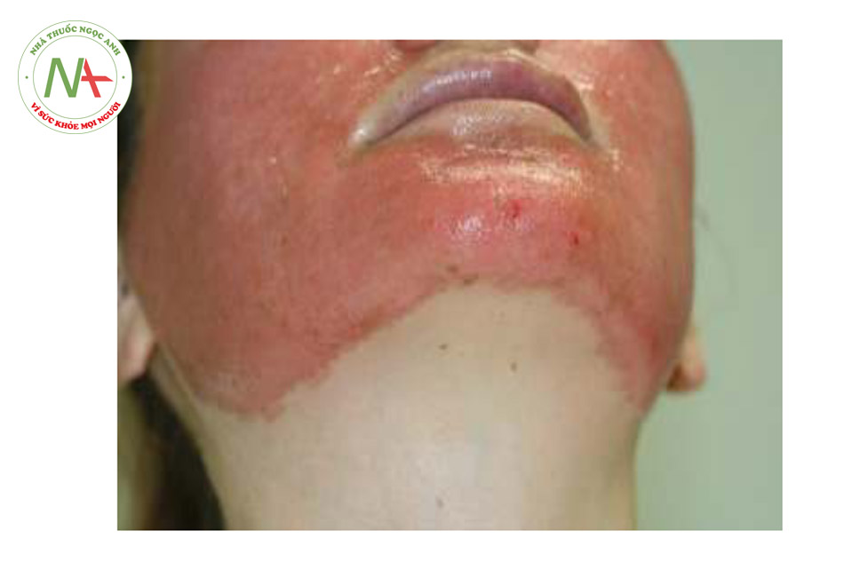 HÌNH 9 Điều trị laser xâm lấn trên phần mặt dưới mở rộng cho đến dưới đường hàm. (với sự cho phép của BS R. Small).