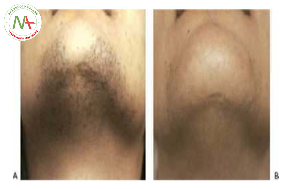 HÌNH 12 Lông vùng cằm trước khi (A)và sau khi (B)bốn lần điều trị triệt lông sử dụng laser 755 nm.