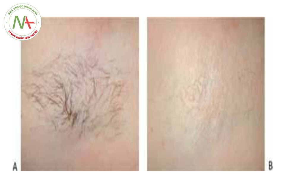 HÌNH 15 Lông nách trước khi (A)và sau khi (B)4 lần điều trị triệt lông với ánh sáng xung mạnh.