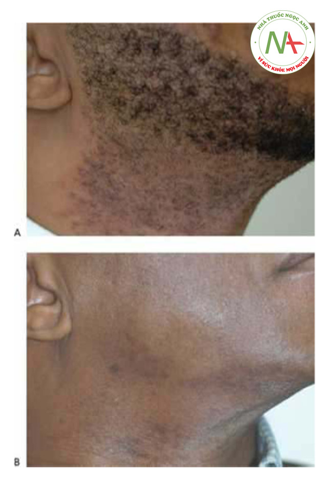 • Hình 18 cho thấy giả viêm nang râu ở bệnh nhân phân loại da Fitzpat-rick loại VI trước khi (A) và sau khi (B) mười hai lần điều trị bằng cách sử dụng laser xung dài 1064 nm (ClearScan YAG™, Sciton).