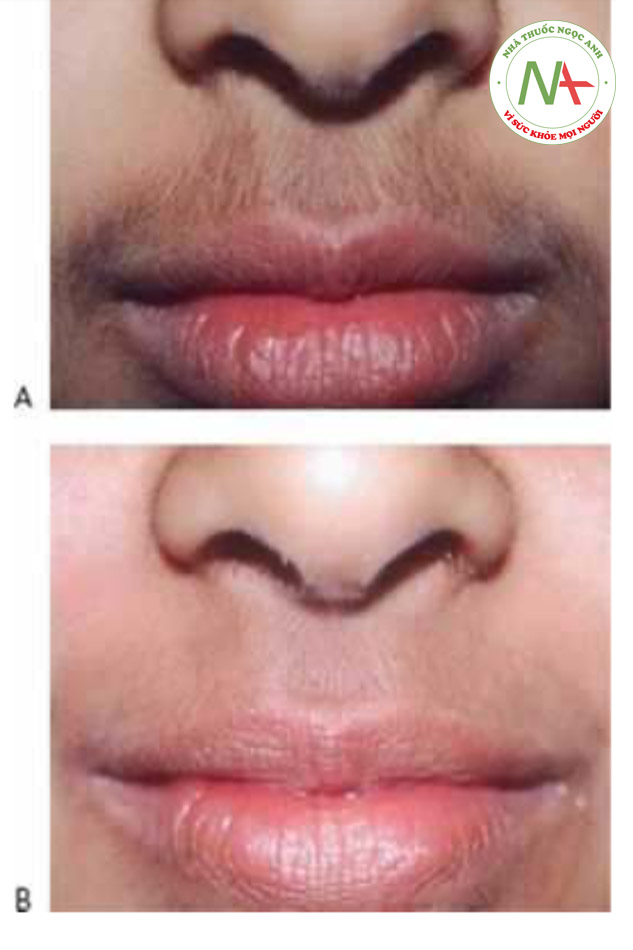 • Hình 16 cho thấy lông môi trên mỏng, tối màu theo phân loại da Fitz-patrick trước khi (A) và sau khi (B) một loạt lần điều trị bằng cách sử dụng Q-switching 1064 nm (RevLite®, Cynenses / ConBio).