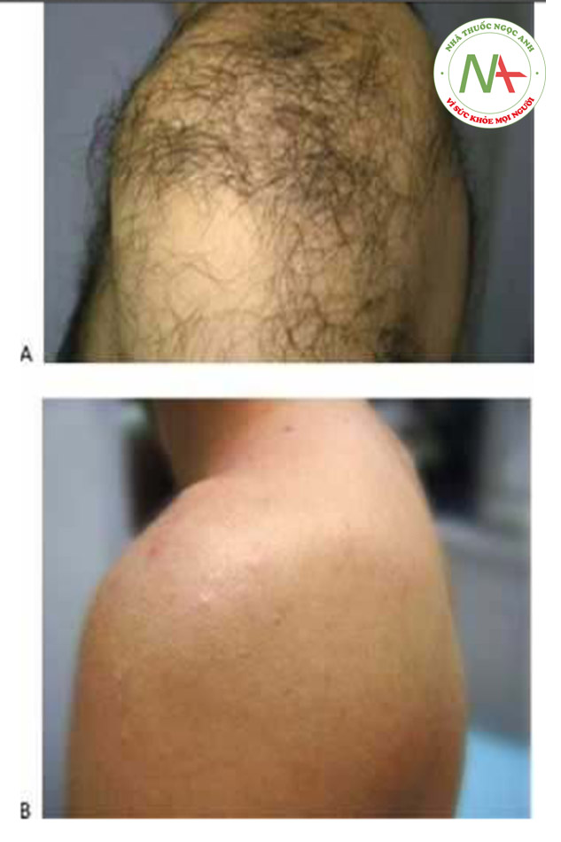 HÌNH 14 Lông ở vai và lưng trên trước khi (A)và sau khi (B)chuỗi điều trị triệt lông sử dụng laser 755 nm