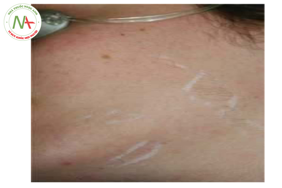 HÌNH 10 Các mảng lông phát triển trên vùng má của bệnh nhân, cằm, và đường ngoại biên vùng cổ trước với 1 bút chì trằng đánh dấu các vùng điều trị LHR.