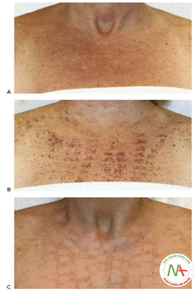 HÌNH 17 Màu da đồng do quang hóa da vùng ngực với nốt ruồi ở bệnh nhân có loại da sáng theo phân loại da Fitzpatrick trước khi (A), 5 ngày sau khi hình thành vỏ (B), và 1 tháng sau khi hình thành sọc (C), 1 lần điều trị với IPL