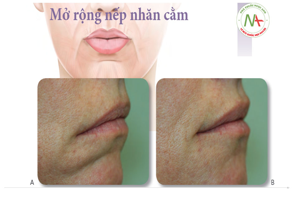 Mở rộng nếp nhăn cằm