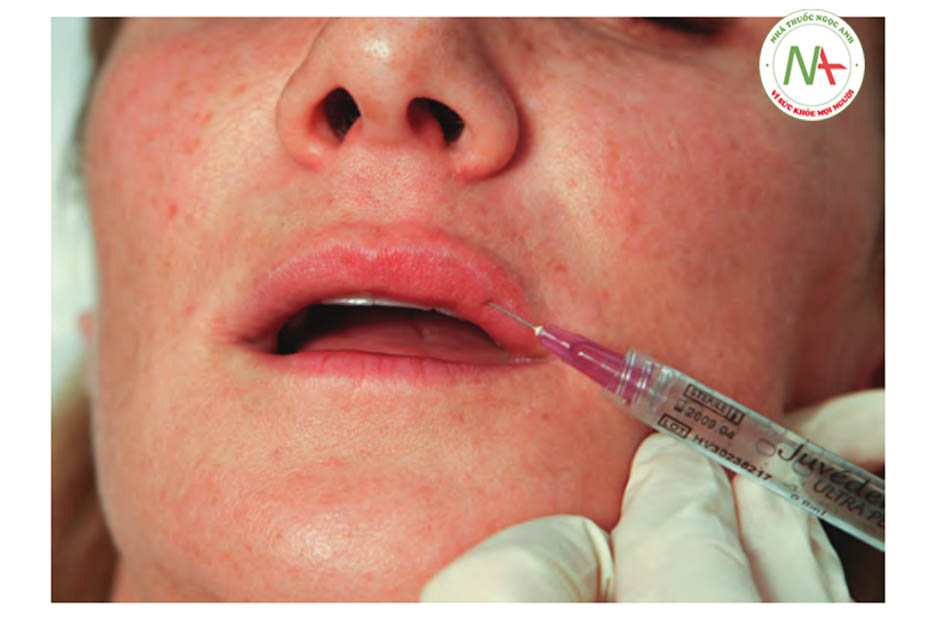 Hình 3 ●Mũi tiêm đầu tiên trong quá trình điều trị đưa chất làm đầy vào môi trên