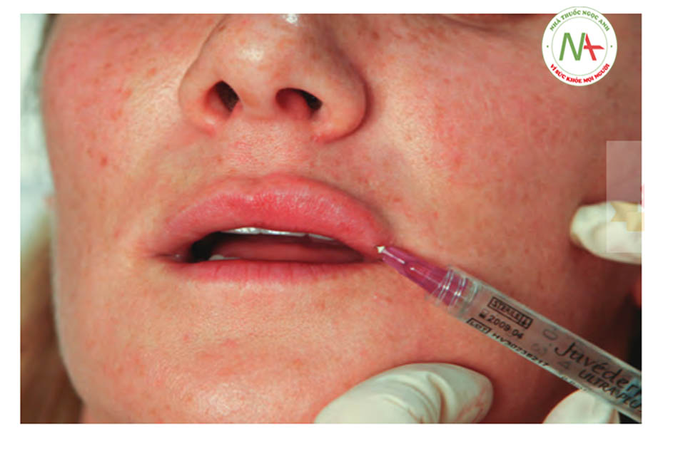 .Hình 4 ●Mũi tiêm thứ hai trong quá trình điều trị đưa chất làm đầy vào môi trên