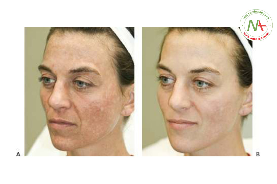 Hình 14 cho thấy nám trên mặt trước khi (A) và sau khi (B) sáu lần điều trị bằng cách sử dụng laser QS 1064 nm (RevLite ™, Cynosure / ConBio).