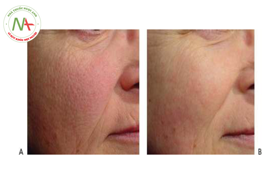 .Hình 7 cho thấy nếp nhăn trên khuôn mặt trước khi (A) và sau khi (B) một loạt sáu lần điều trị tái tạo bề mặt da không xâm lấn bằng cách sử dụng laser xung dài 1064 nm Nd: YAG (Laser Genesis ™, Cutera).