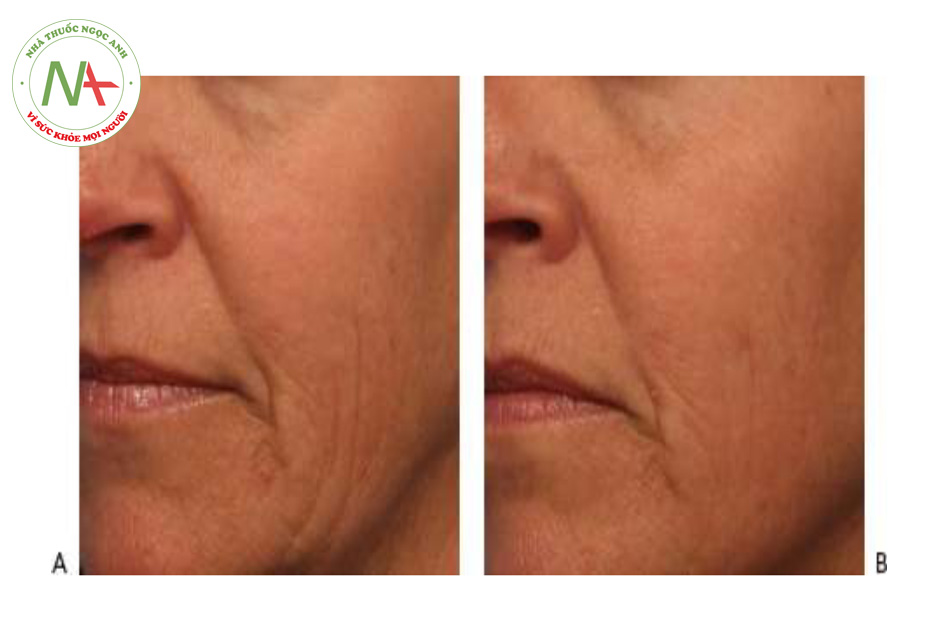 Hình 9 cho thấy nếp nhăn vùng má trước khi (A) và sau khi (B) hai lần điều trị tái tạo bề mặt da không xâm lấn bằng cách sử dụng laser 1565 nm (ResurFX ™, Lumenis)