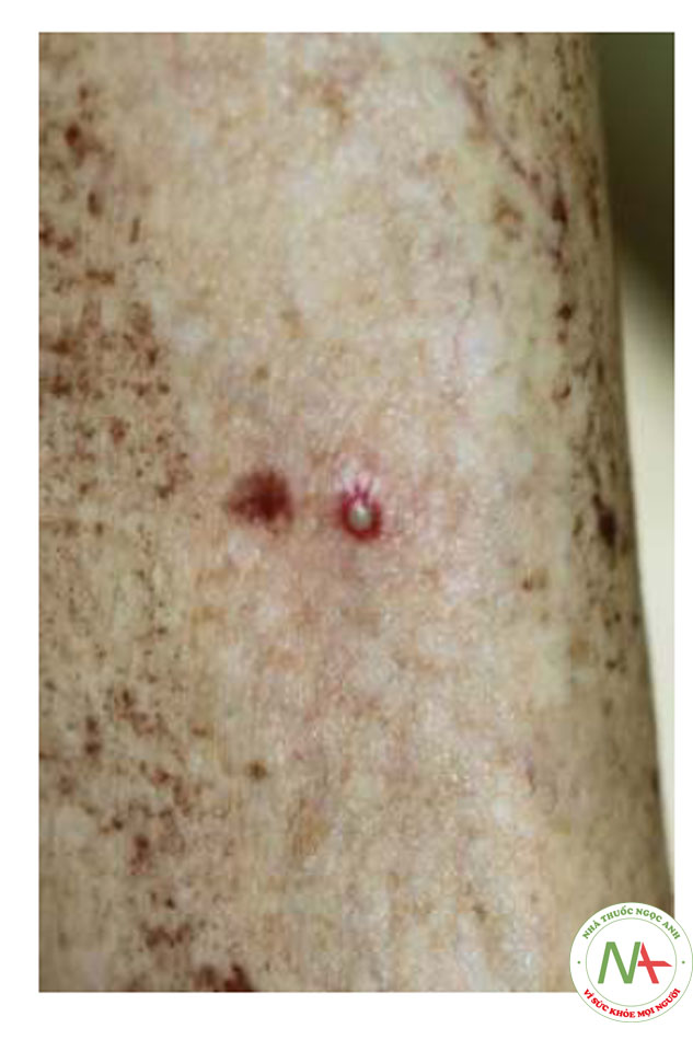 HÌNH 16 Nhiễm trùng do vi khuẩn ở chân khu vực được cạo 2 tuần sau khi điều trị IPL.
