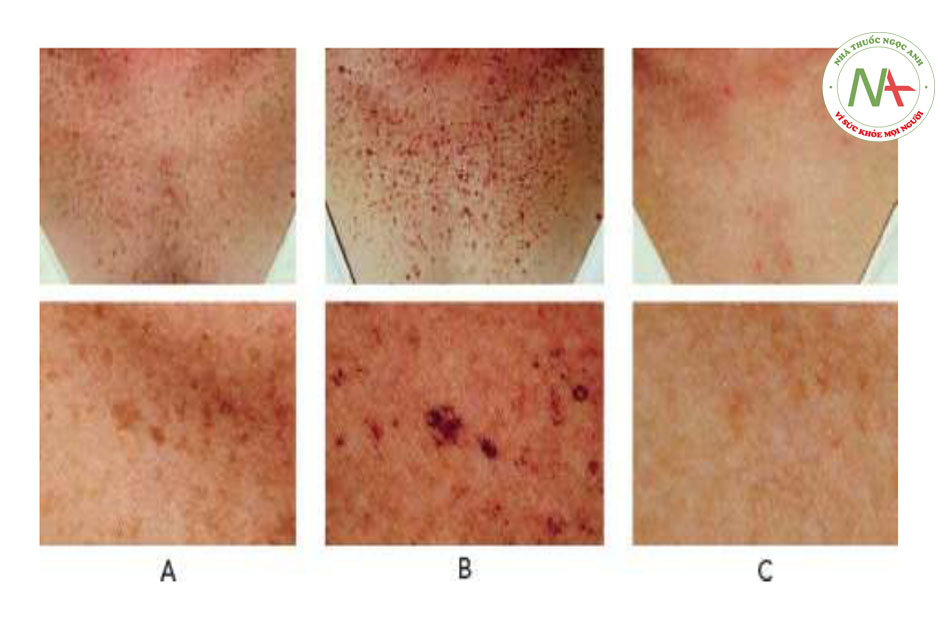 HÌNH 6 Các nốt ruồi và tàn nhang ở ngực khi nhìn gần trước khi (A), một tuần sau khi điều trị cho thấy các tổn thương sắc tố tối đi do sự hình thành các lớp vỏ nhỏ (B), và hai tuần sau điều trị (C), sử dụng ánh sáng xung mạnh IPL