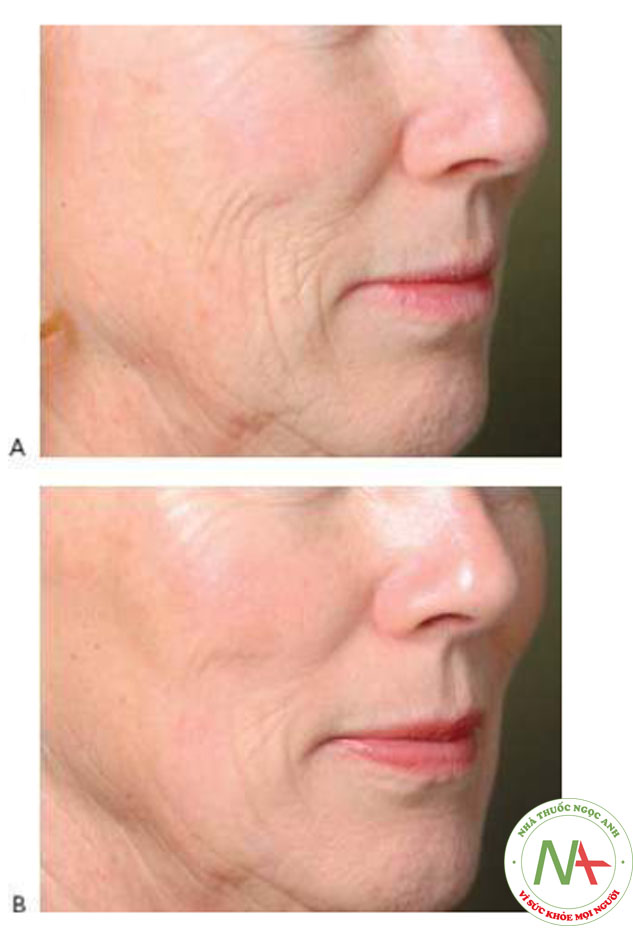Hình 17 cho thấy các nếp nhăn trên khuôn mặt trước khi (A) và sau khi (B) một lần điều trị tái tạo bề mặt da xâm lấn phân đoạn bằng cách sử dụng laser erbium (Profractional-XC ™, Sciton).