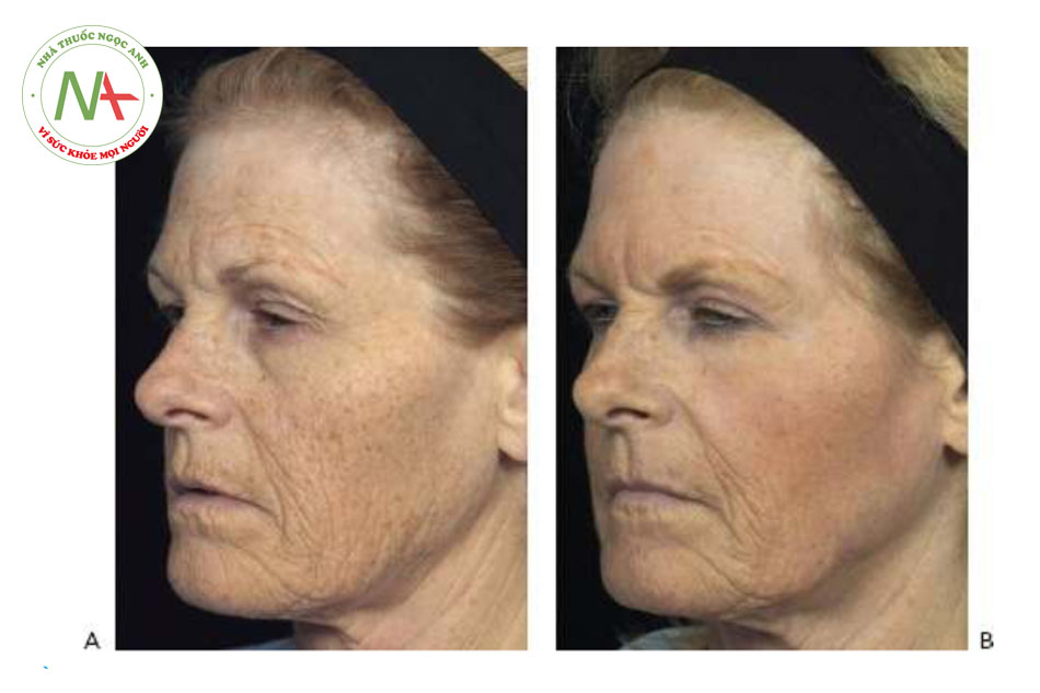 HÌNH 14 Tái tạo bề mặt da phân đoạn xâm lấn để điều trị nếp nhăn vùng mặt và màu da trước khi (A) và sau khi (B) 1 lần điều trị sử dụng laser carbon dioxide. (với sự cho phép của BS Z. Rahman và Solta.