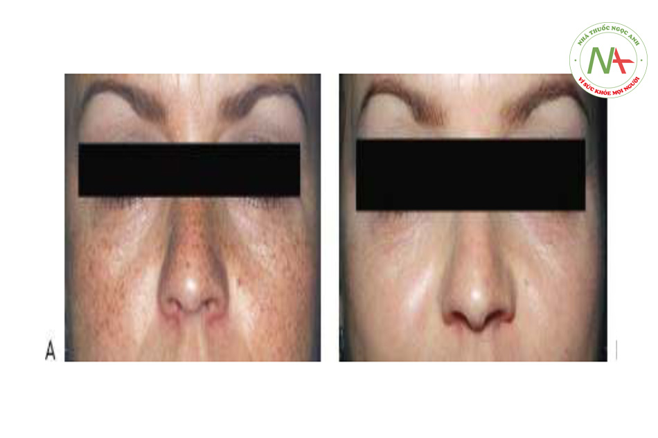 Hình 11 cho thấy tàn nhang trên mặt trước khi (A) và sau khi (B) một lần điều trị bằng cách sử dụng laser QS 532 nm (Laser Peel ™, Medlite ™ Cyn-enses / ConBio).