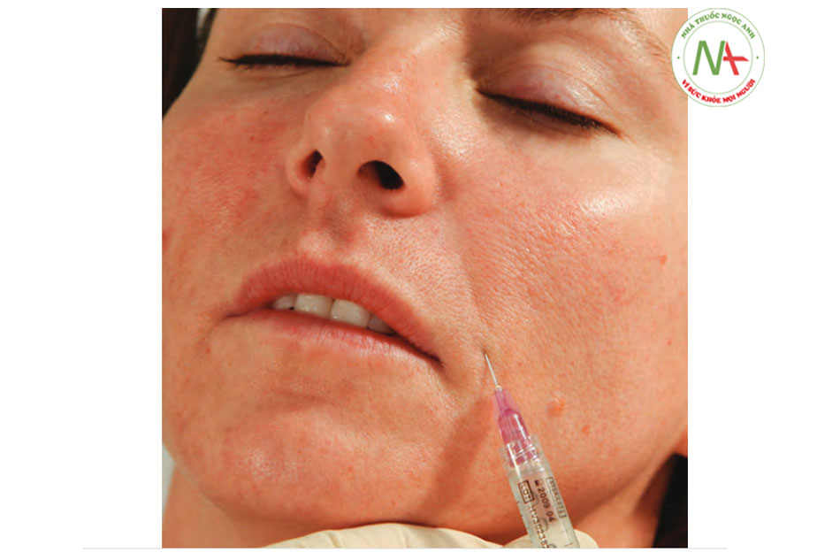 FIGURE 4 ●Lần tiêm đầu tiên để điều trị làm đầy da mặt nếp gấp mũi - má.