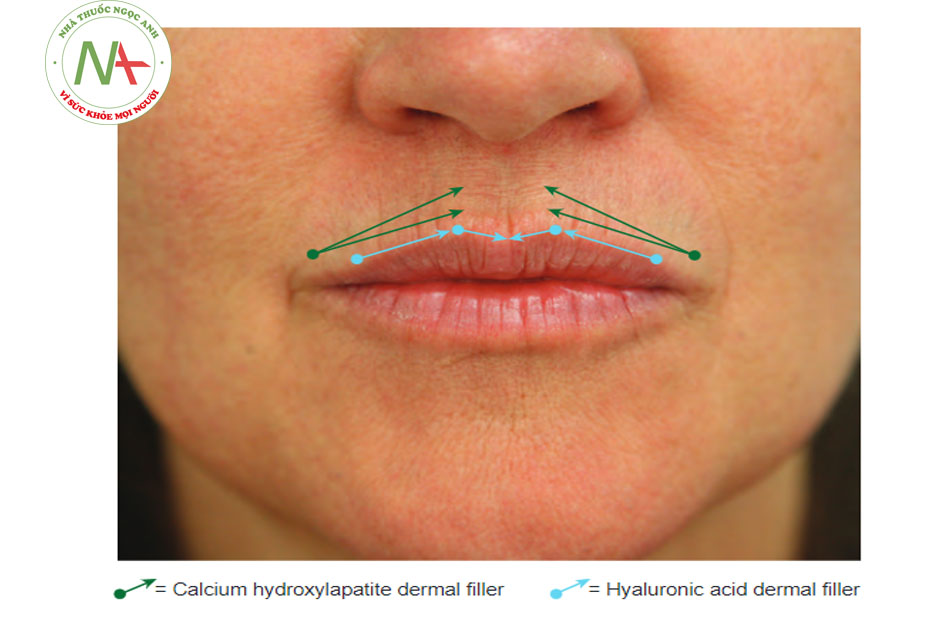 Hình 4 ●Tiêm trên môi trên trong quá trình điều trị bằng chất làm đầy đối với các rãnh môi: xác định điểm đưa mũi kim vào (A) và kĩ thuật tiêm (B)