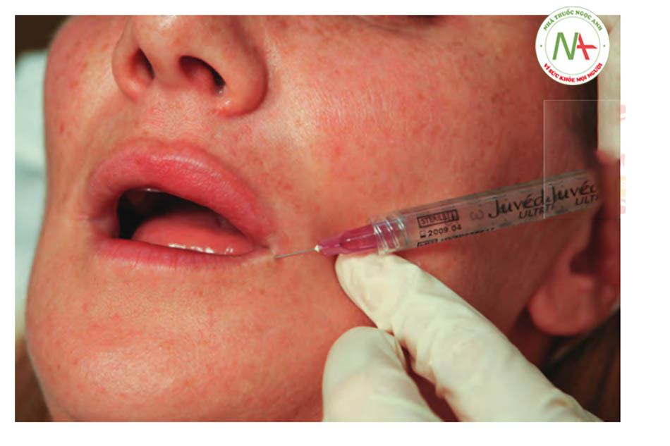 FIGURE 8 ●Mũi tiêm thứ ba cho điều trị làm đầy da của viền môi dưới.