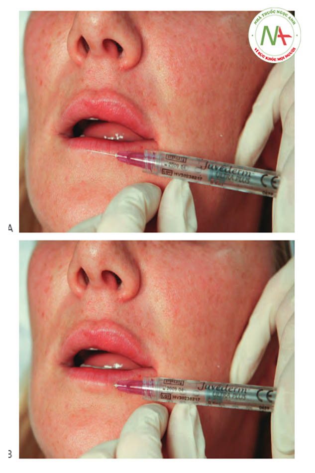 FIGURE 6 ●Lần tiêm đầu tiên cho điều trị làm đầy da viền môi dưới: xác định điểm chèn kim (A) và kỹ thuật tiêm (B)