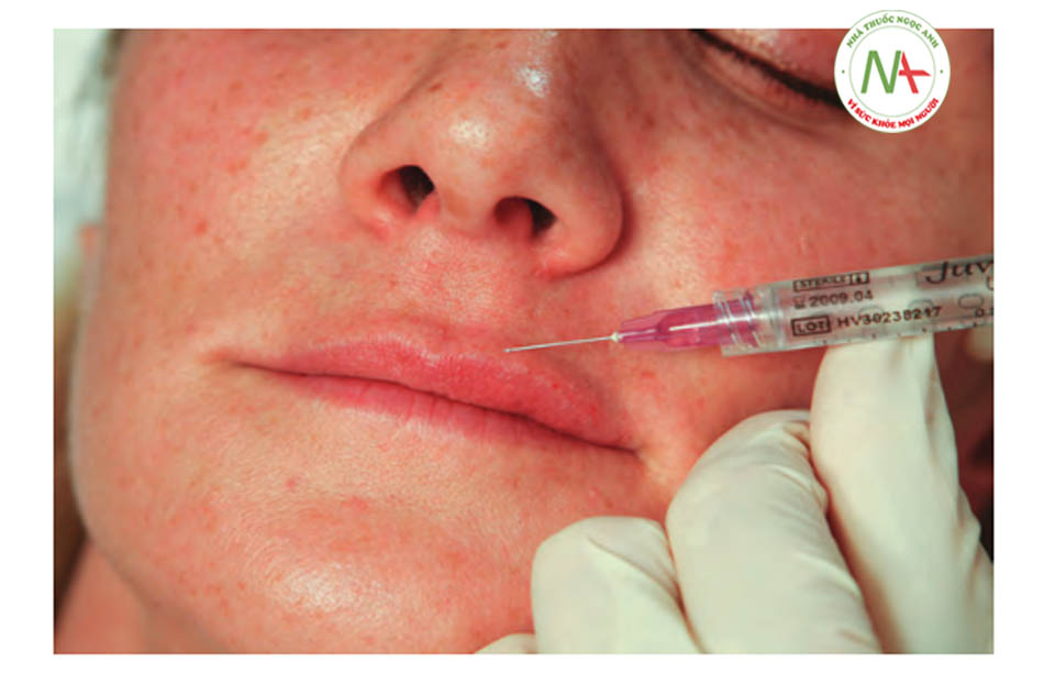 FIGURE 4●Second injection for dermal filler treatment of the upper lip border
