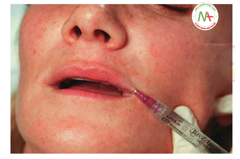 FIGURE 5 ●Điểm tiêm thứ ba cho điều trị làm đầy da của viền môi trên.