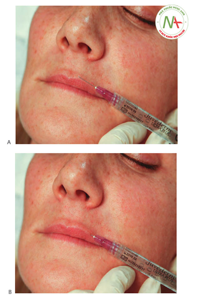 FIGURE 3 ●Lần tiêm đầu tiên cho điều trị làm đầy da của viền môi trên: xác định điểm chèn kim (A) và kỹ thuật tiêm (B)