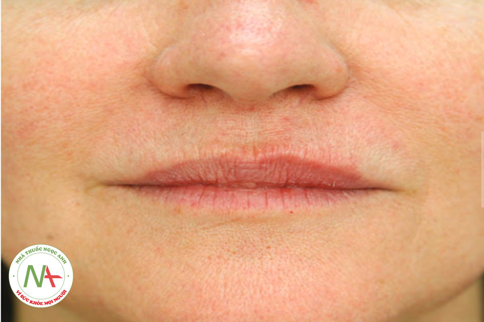 Hình 6 ●Viền môi trên bên trái ngay sau khi điều trị bằng chất làm đầy bằng axit hyaluronic.