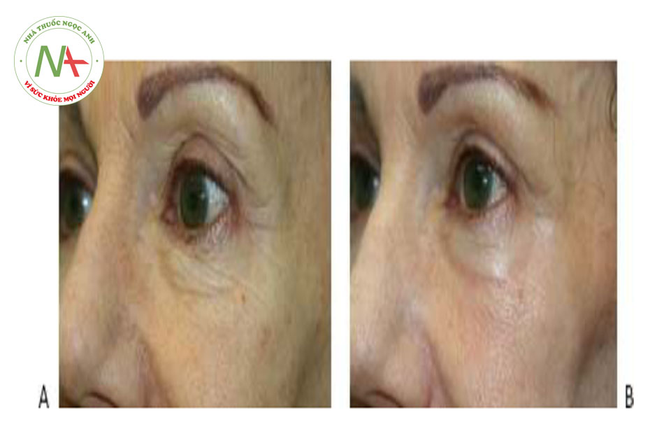 Hình 18 cho thấy nếp nhăn quanh mắt trước khi (A) và sau khi (B) một lần điều trị tái tạo bề mặt da xâm lấn phân đoạn bằng cách sử dụng laser erbium (Lux 2940 ™, Cynosure / Palomar).