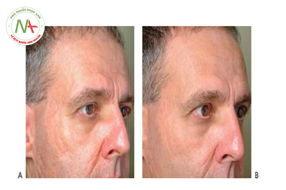 Hình 19 cho thấy sẹo mụn trước khi (A) và sau khi (B) năm lần điều trị tái tạo bề mặt da xâm lấn phân đoạnn bằng cách sử dụng laser erbium (Prof-ractional-XC ™, Sciton).