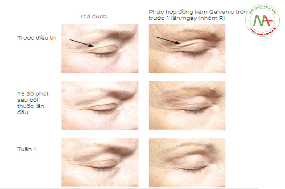 Hình 18.1 Hình ảnh những bệnh nhân được điều trị với phức hợp Kẽm - Đồng galvanic cho thấy sự cải thiện lão hóa ở mi mắt ngay lập tức và liên tục.