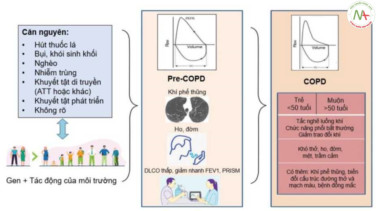 Hình 1.6. COPD là kết quả của sự tương tác theo thời gian giữa đặc tính di truyền của một số cá nhân với các tácnhân gây bệnh khác nhau 