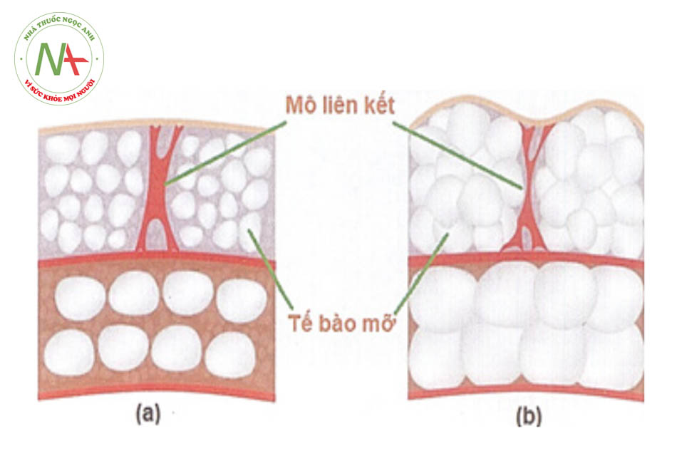 Hình 19.1. So sánh cấu tạo da bình thường(a) và khi cellulite (b