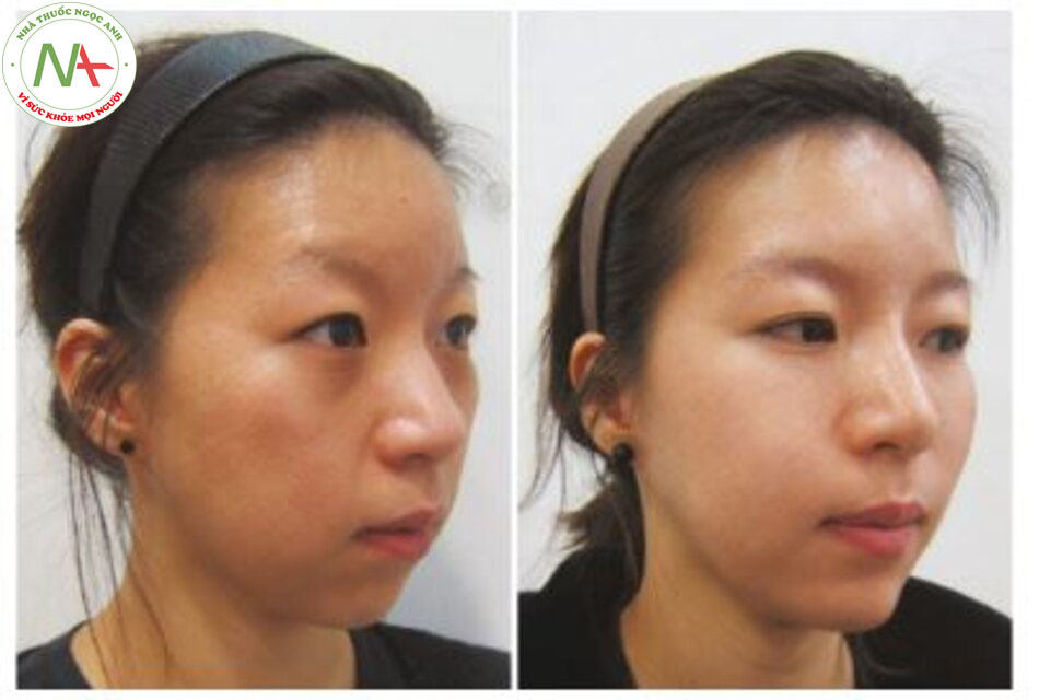 Hình 2.2 Việc sử dụng chất làm đầy dạng tiêm để tạo hiệu ứng ba chiều và tăng độ căng da. Một bệnh nhân nữ 31 tuổi cho thấy những thay đổi rõ rệt sau khi được tiêm chất làm đầy tạo khối cho vùng má hóp, mũi, cằm và vùng má trước