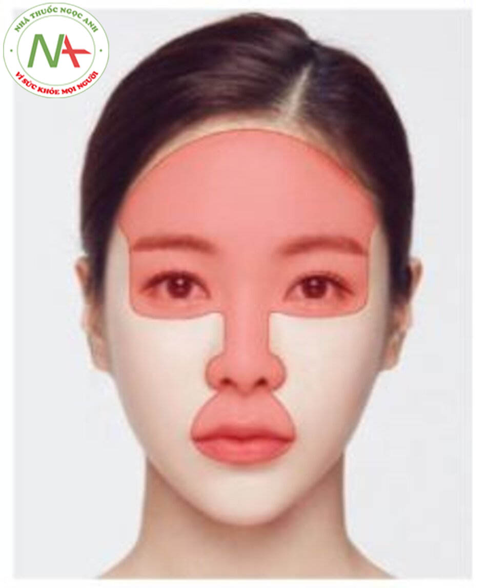Hình. 2.47 PLLA nên tránh ở những vùng da mỏng như vùng quanh mắt, trán và mũi, và ở những vùng động như vùng quanh miệng và môi