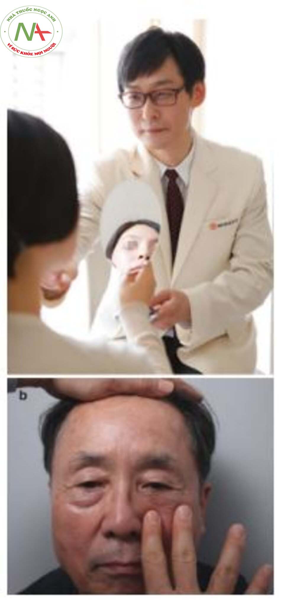 Hình 1.1 (a) Tư vấn qua gương, (b) Bệnh nhân 72 tuổi với bọng mắt lồi và rãnh lệ được cho thấy kết quả mô phỏng sau khi tiêm chất làm đầy thông qua "tư vấn qua gương" 