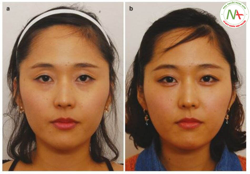 Hình 1.25 (a) Trước và (b) sau khi tăng bọng mắt kết hợp với bơm chất làm đầy cho mắt trũng và rãnh lệ.