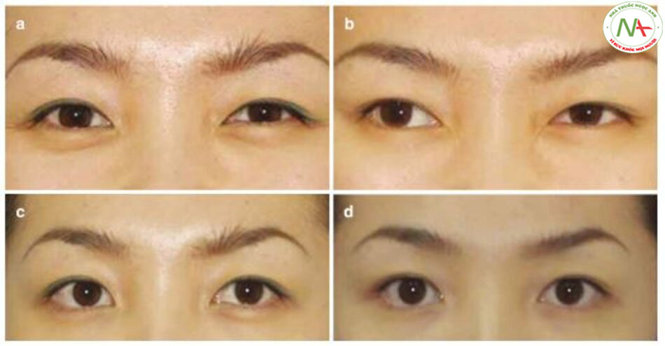 Hình 1.26 (a, c) Trước và (b, d) sau khi loại bỏ bọng mắt dưới bằng cách tiêm độc tố botulinum.