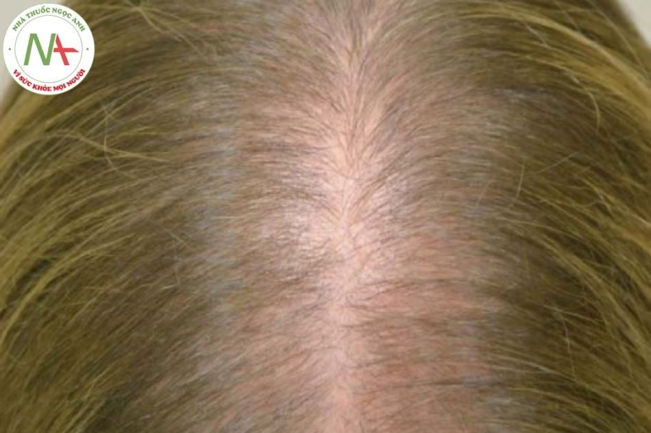 Hình 24.1 Ví dụ lâm sàng về rụng tóc kiểu phụ nữ.