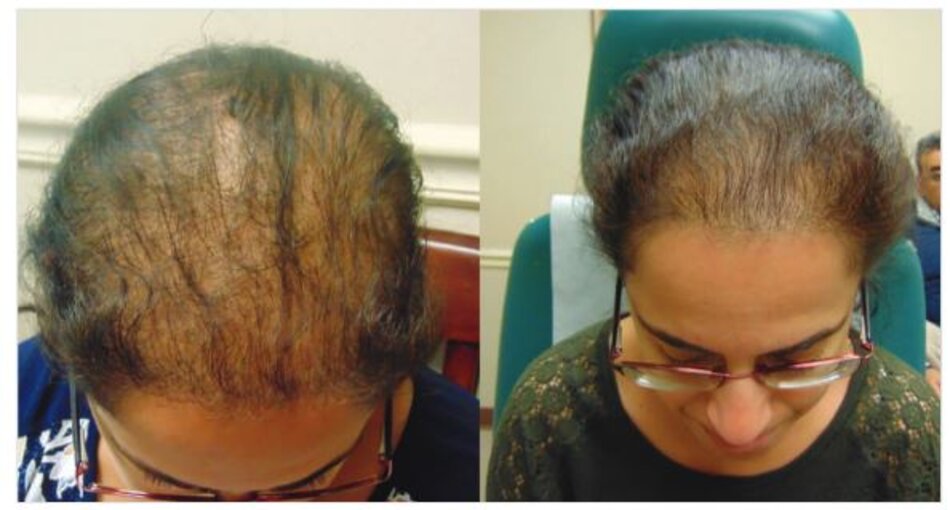 Hình 4.4 Trước và sau 6 lần điều trị PRP ở một phụ nữ 43 tuổi.