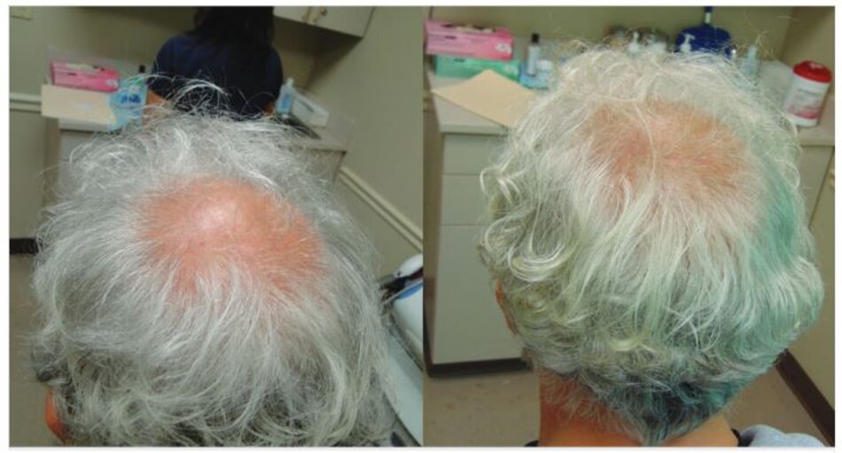 Hình 4.6 Trước và sau 3 lần điều trị PRP ở bệnh nhân nam 61 tuổi.