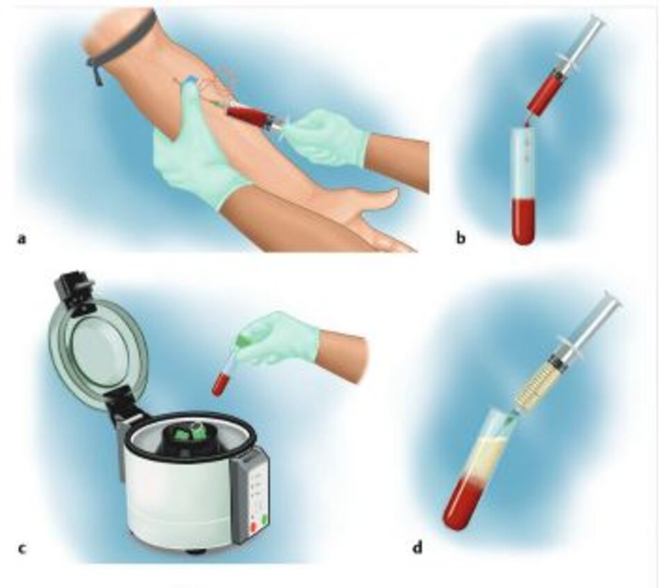 Hình 1.2 Các bước thu thập huyết tương giàu tiểu cầu (PRP) trong phương pháp quay đơn. (a) Bước 1: lấy máu — chọc dò tĩnh mạch từ tĩnh mạch antecubital. (b) Bước 2: chuyển máu vào ống thu gom để ly tâm. (c) Bước 3: Cho bệnh phẩm vào máy ly tâm. (d) Bước 4: Rút lớp PRP vào ống tiêm sau ly tâm. (e) Bước 5: Bơm tiêm chỉ sẵn sàng tiêm PRP.