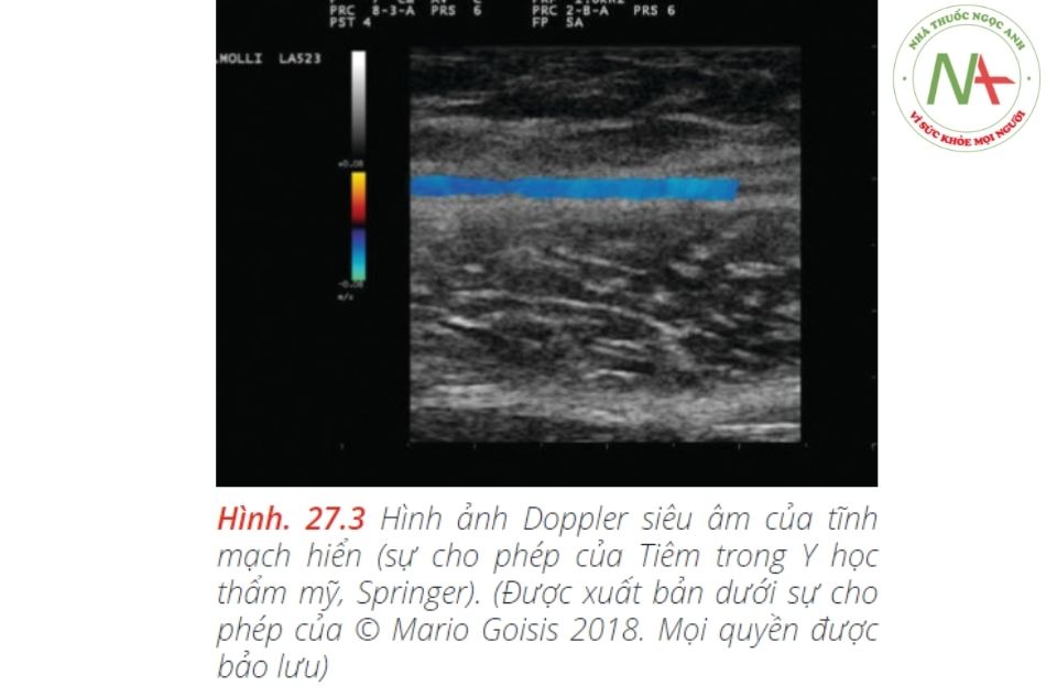 Hình ảnh Doppler siêu âm của tĩnh mạch hiển (