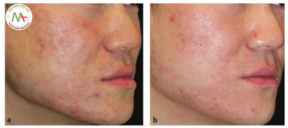 Hình. 6.4 Sẹo rỗ do mụn trên mặt ở (a) lúc ban đầu và (b) 6 tháng sau ba lần điều trị lăn kim vi điểm định kỳ hàng tháng.
